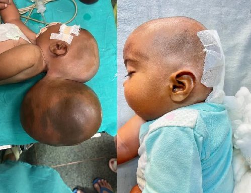 5 महीने की बच्ची के सिर से 2 किलोग्राम की बड़ी गांठ निकाली